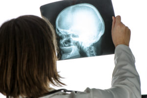 Doctor analyzing  x-ray of brain injury in hospital office during medical exam