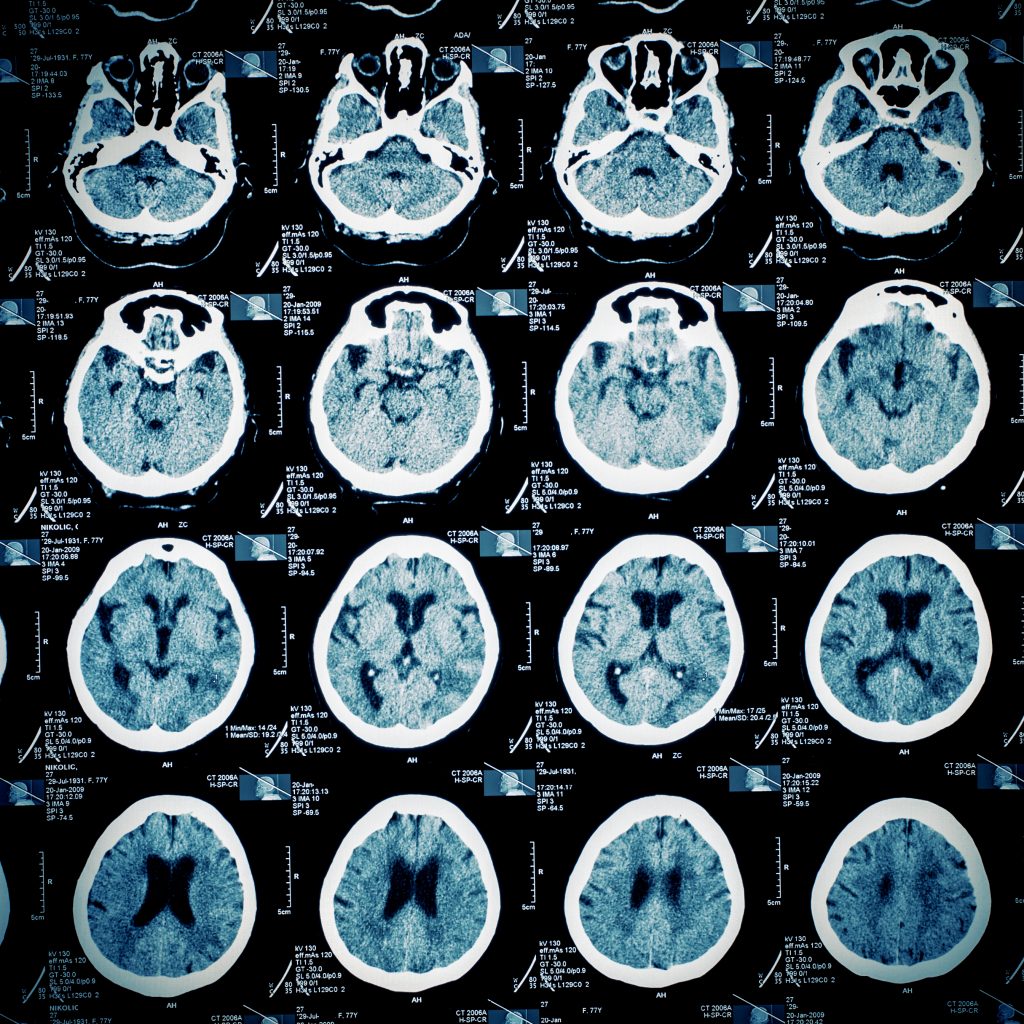 MRI scan of a human brain